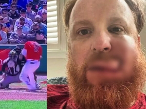 Justin Turner muestra c&oacute;mo le qued&oacute; la cara tras recibir pelotazo; requiri&oacute; 16 puntadas