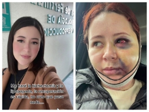 De bella a deformada, as&iacute; sufri&oacute; joven tras hacerse una bichectom&iacute;a